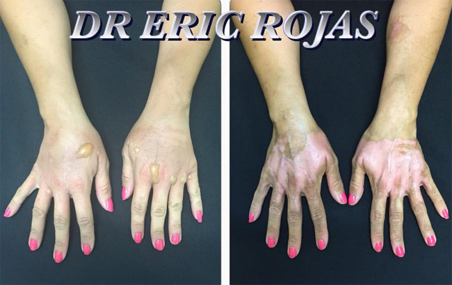 FITOFOTODERMATOSIS quemadura causada por el contacto con cítricos mas las luz del sol o luz ultravioleta