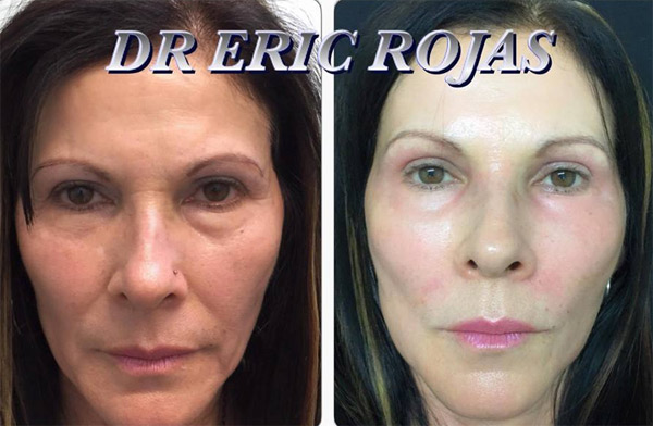 Rejuvenece tu rostro sin cirugía