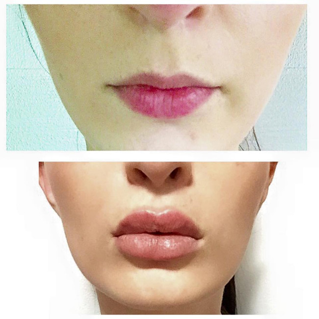 AUMENTO DE LABIOS