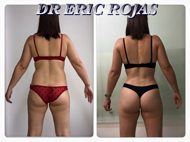 SLIM LASER logramos cambiar el cuerpo…