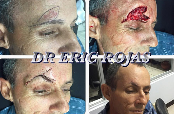 Increíble lo que logramos hacer con los dermatólogos con  CIRUGÍA DERMATOLÓGICA.