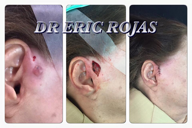 El cáncer de piel si se trata a tiempo se se resuelve de una forma muy simple. Busca tu dermatólogo.