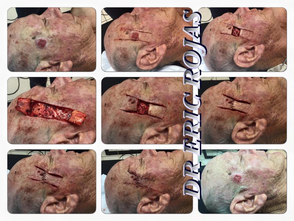 CIRUGÍA DERMATOLÓGICA.