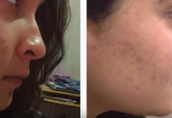 Las marcas que deja el terrible acné en nuestra cara o cuerpo