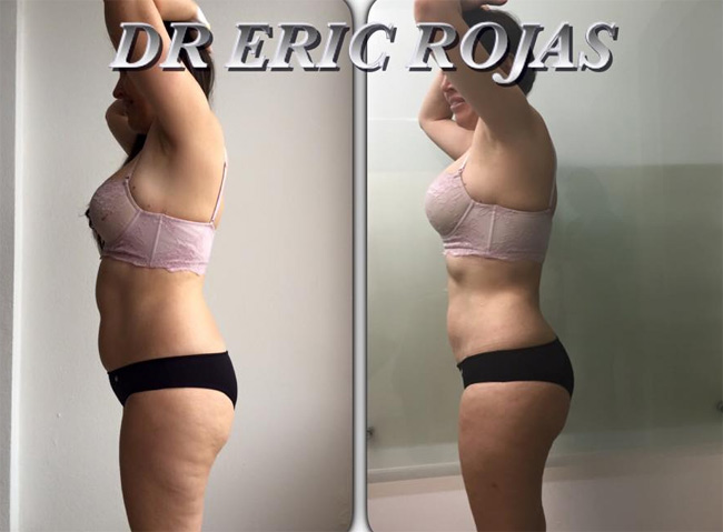 SLIM LASER cambia tu vida. Exclusivo DR ERIC ROJAS