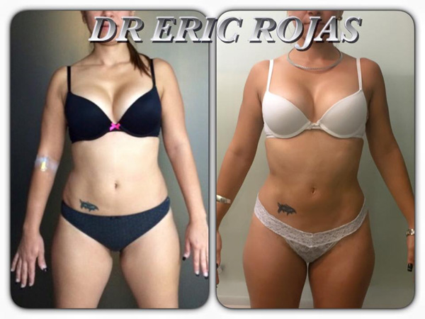 SLIM LASER cambia tu figura y tu vida.