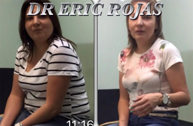 15 kilos menos con nuestro tratamiento para perder peso
