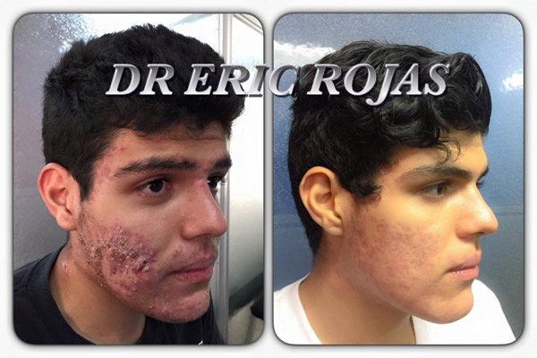 EL ACNE TIENE CURA