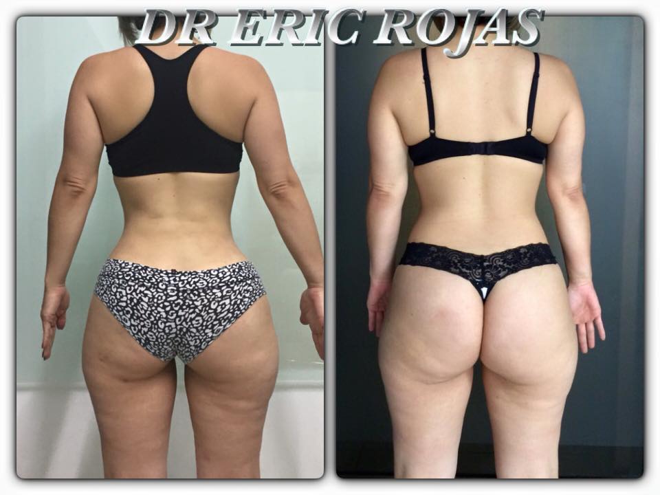 SLIM LASER moldea tu figura y cambia toda tu vida para bien.