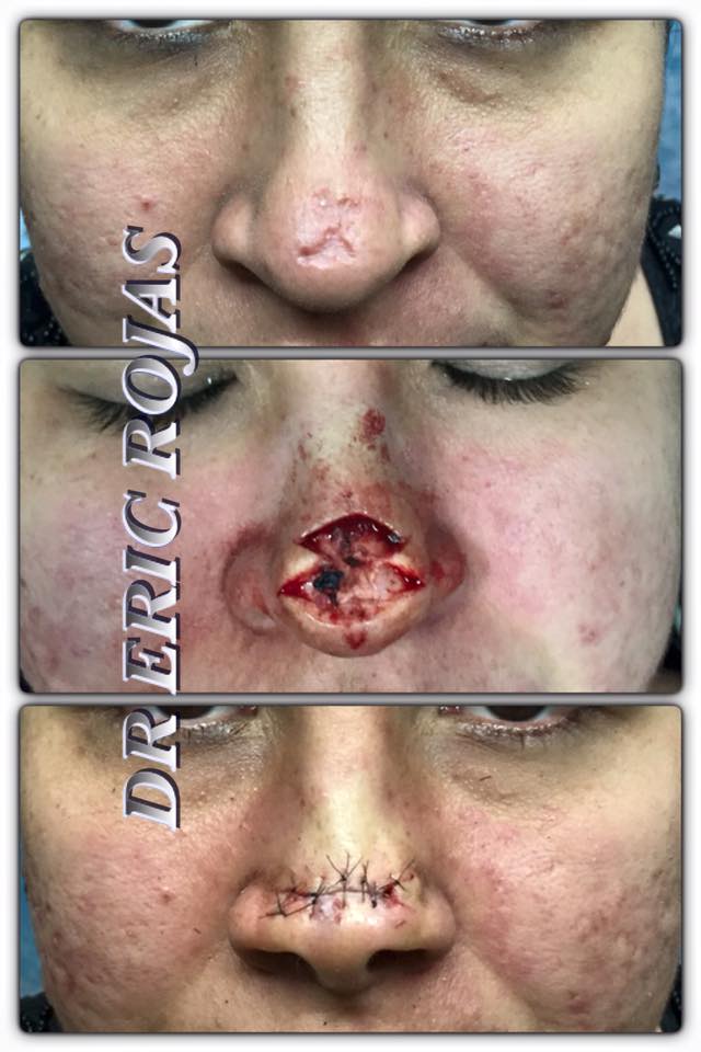 La CIRUGIA DERMATOLOGICA