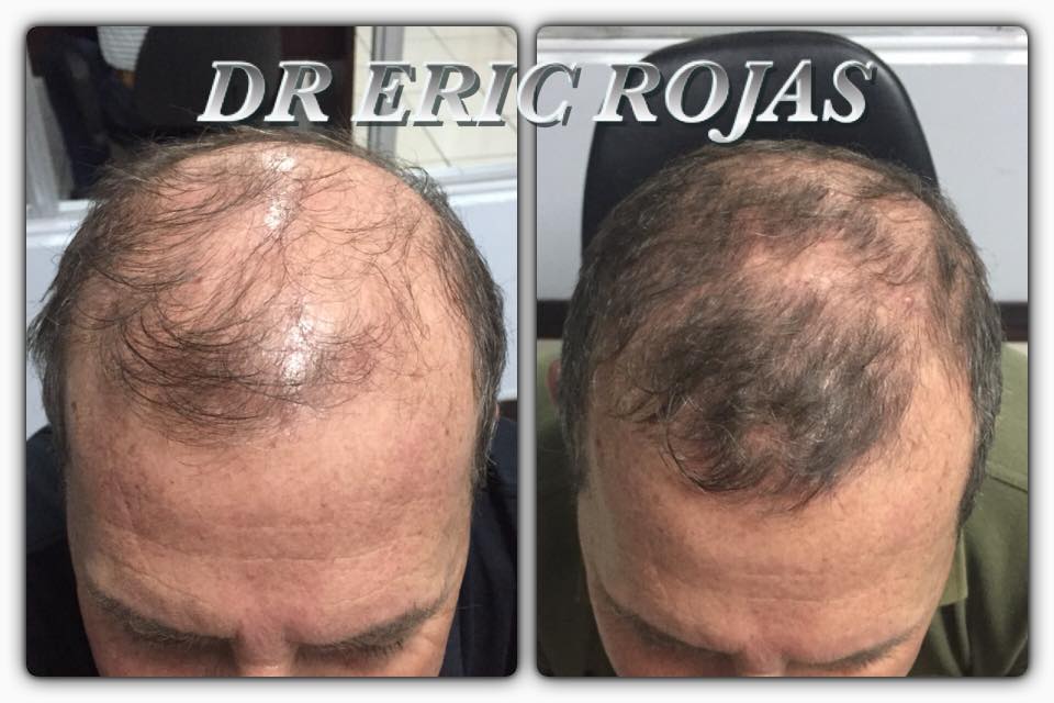 Cuando veo nuestros pacientes felices al mejorar la caída y la cantidad de cabello …