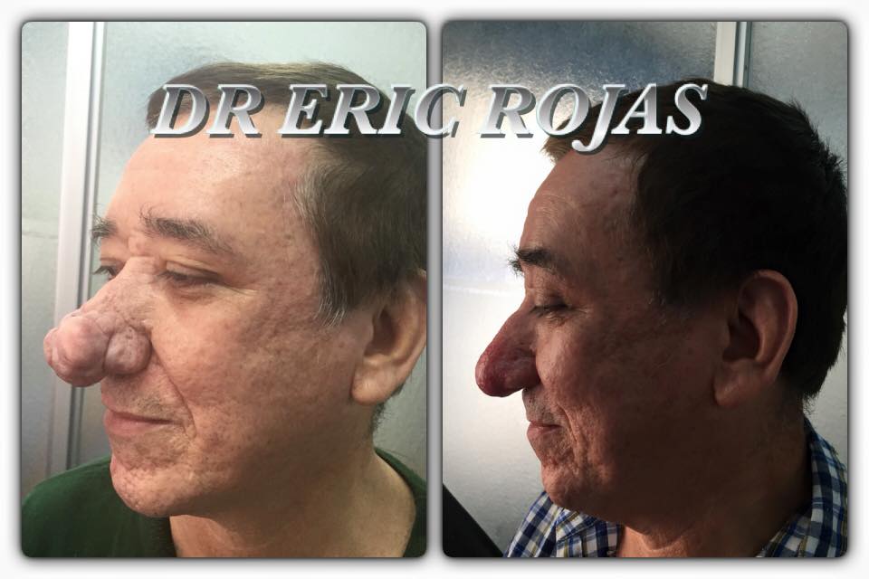 RINOFIMA EN ROSACEA