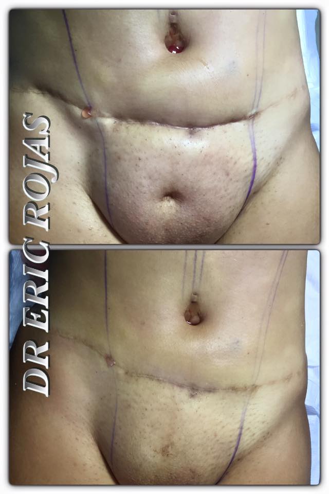 Las cicatrices que quedan después de una Abdominoplastia
