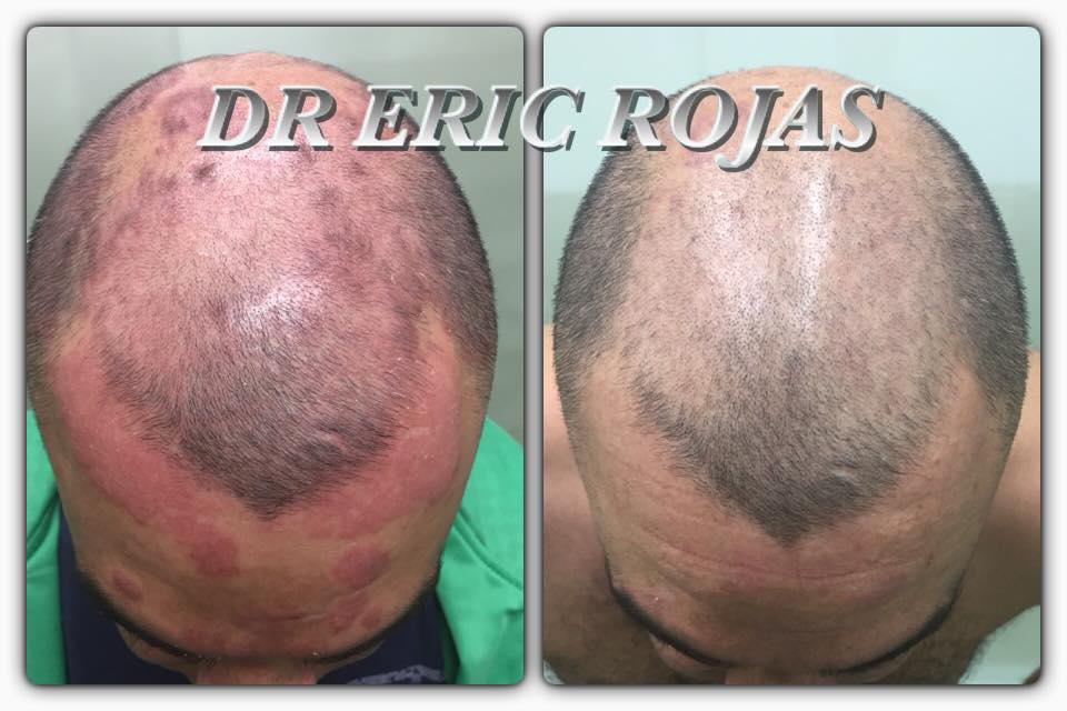 PSORIASIS es una enfermedad de la piel