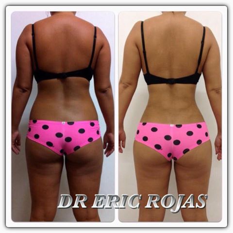 Slim Laser es único y exclusivo del Dr Eric Rojas