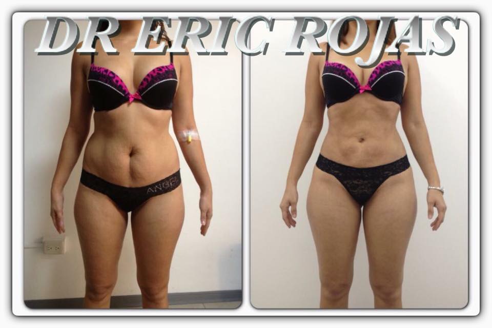 Cambios sorprendentes solo con SLIMLASER