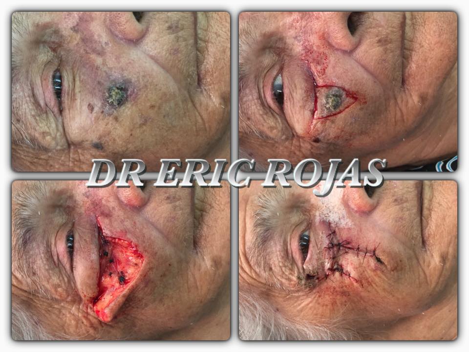 El cáncer de piel es una enfermedad que si se trata a tiempo se cura.