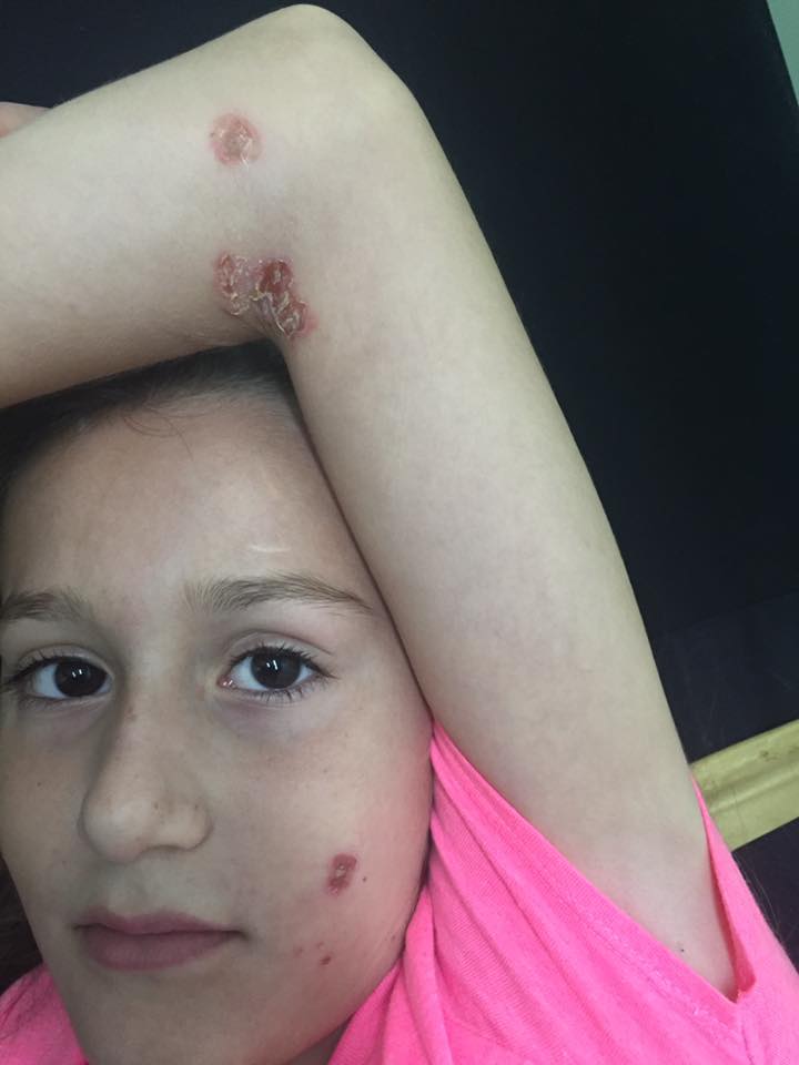 IMPETIGO CONTAGIOSO
