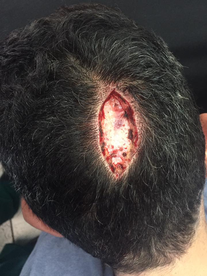 Nuevo sebáceo de Jadasson es un lunar benigno que si se deja muchos años tiende a producir un tumor maligno