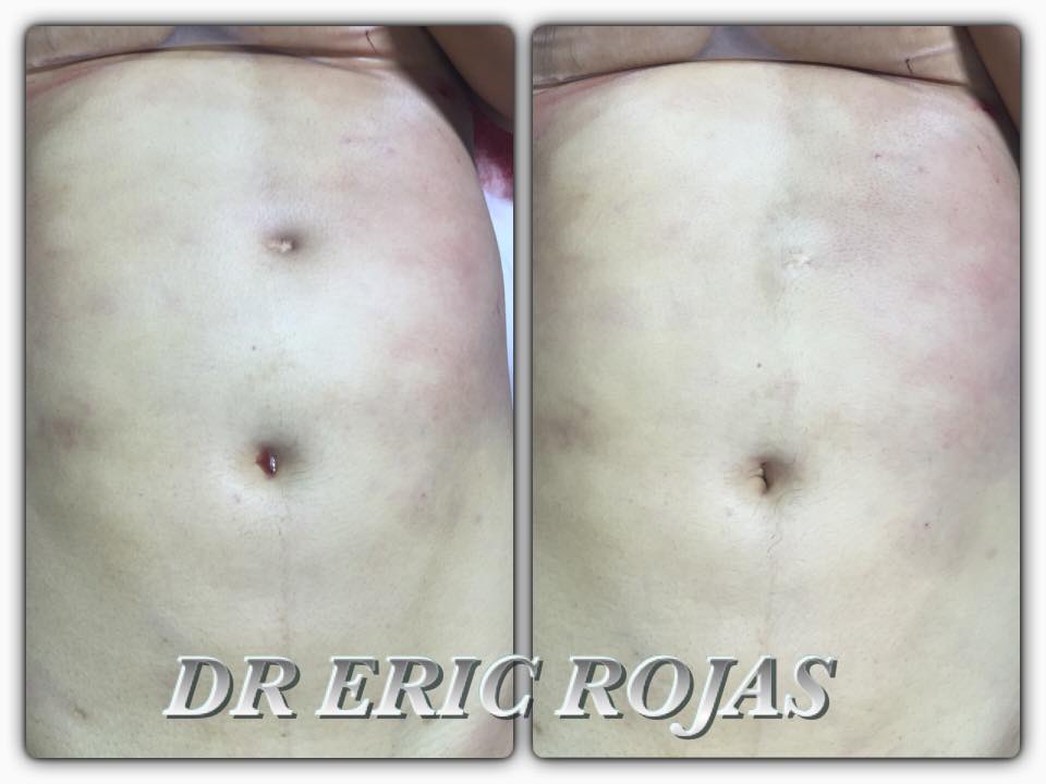 Ese doble ombligo que dejó tu cirugia anterior nosotros lo eliminamos en menos de 5 minutos