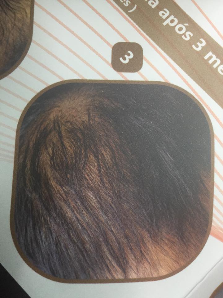 Capellux tratamiento de última generación en tratamiento LEDs roja para pérdida de cabello