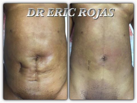 Tú cesárea , cicatriz de apendicectomia, además de una liposucción anterior dan un mal aspecto a tu abdomen.