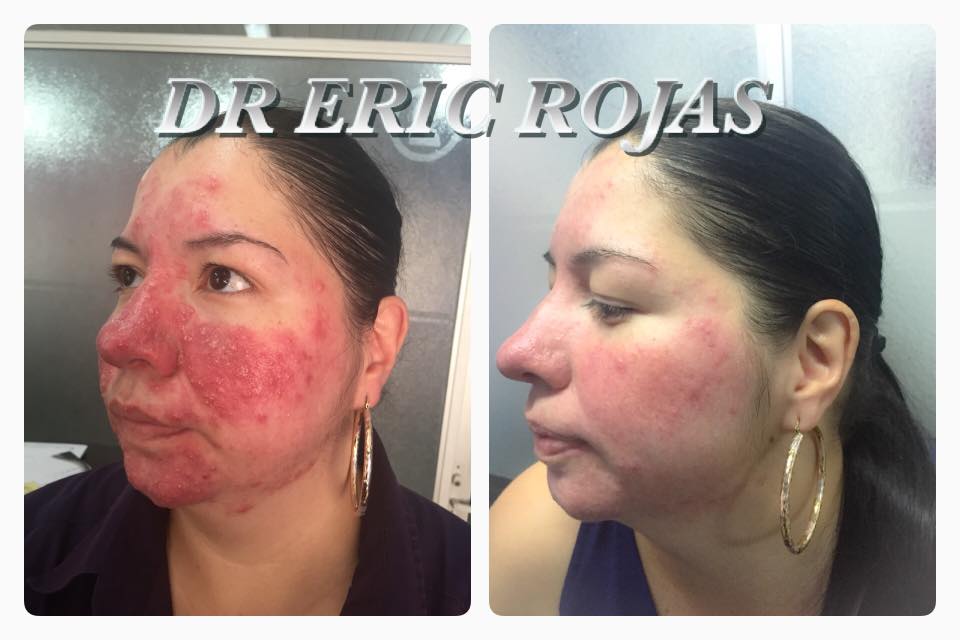 Paciente Zulay Sibaja Venegas con ROSACEA