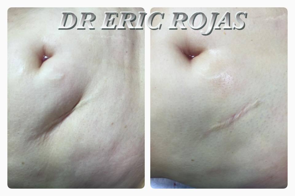 Tú cicatriz podemos mejorarla para que no divida tu abdomen más
