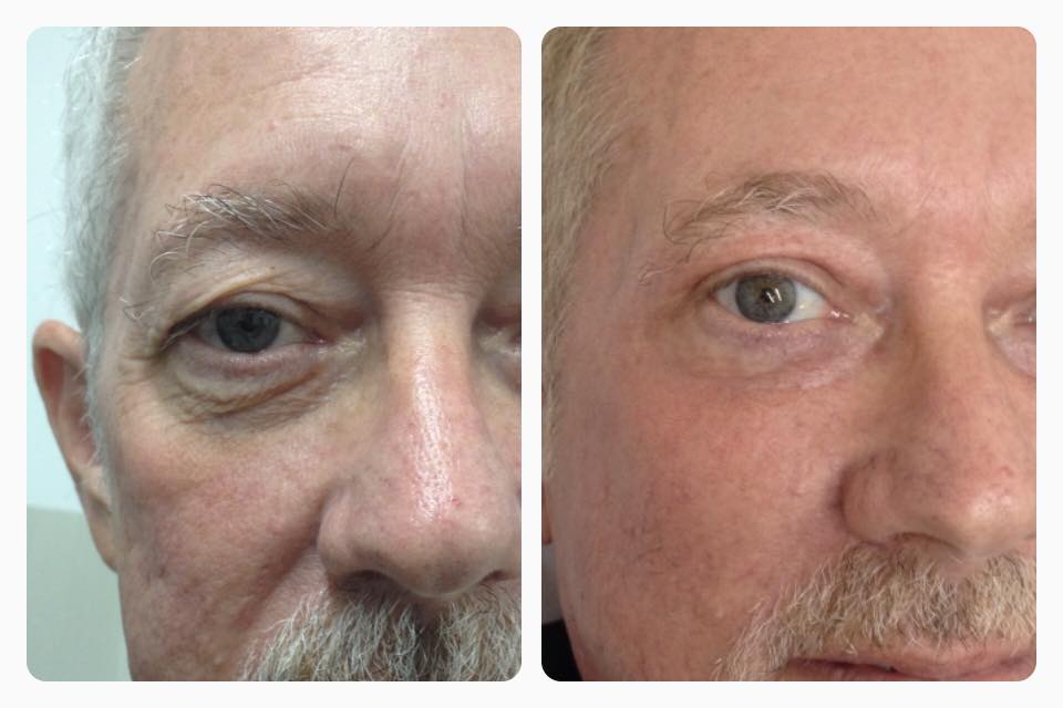 Si quieres rejuveneces tus párpados nosotros tenemos el mejor tratamiento para hacerlo.