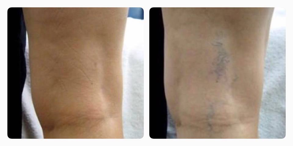 Tenemos el mejor LASER para eliminar las arañitas de la piel de una forma rápida