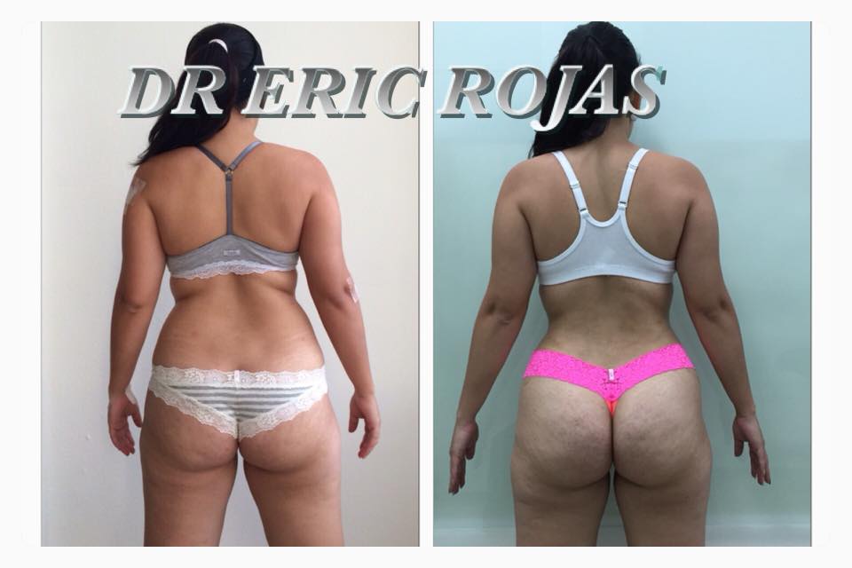 SLIM LASER CAMBIA TU CUERPO