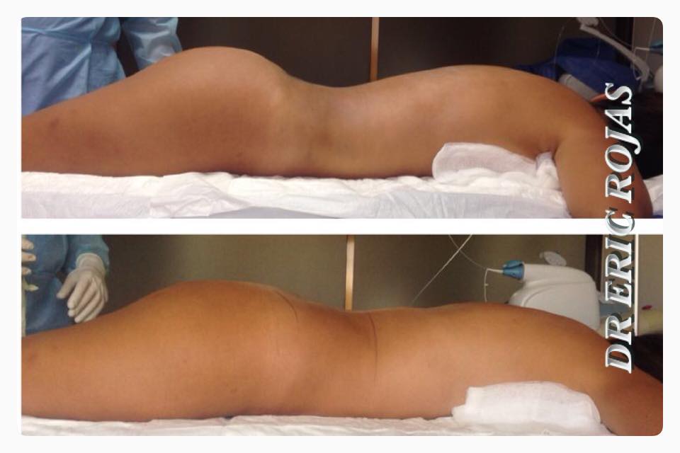 Nosotros cambiamos la forma de tus nalgas.