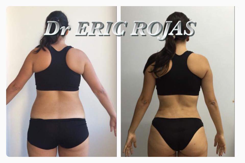 SLIM LASER CAMBIA TU CUERPO Y TODA TU VIDA