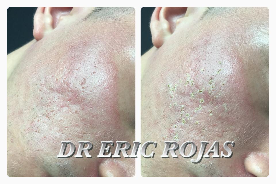 Tenemos un tratamiento láser para mejorar tus marcas de ACNE