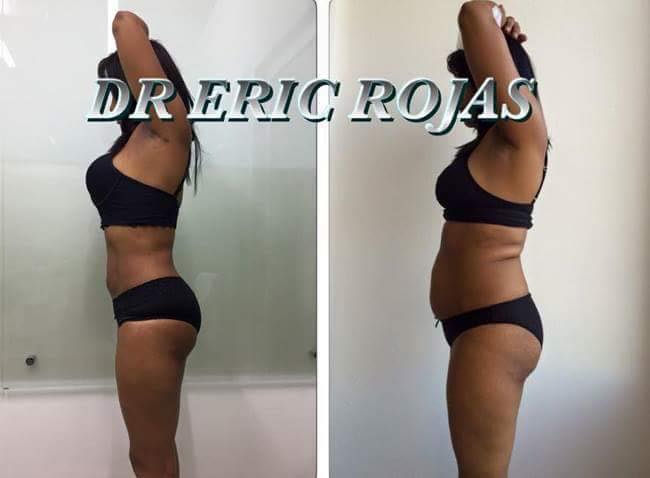 SLIM LASER creado y exclusivo del DR ERIC ROJAS