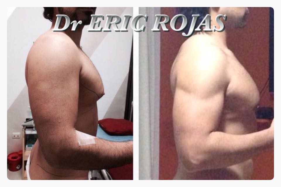 Marcación de brazos. DR ERIC ROJAS, no te conformes con menos