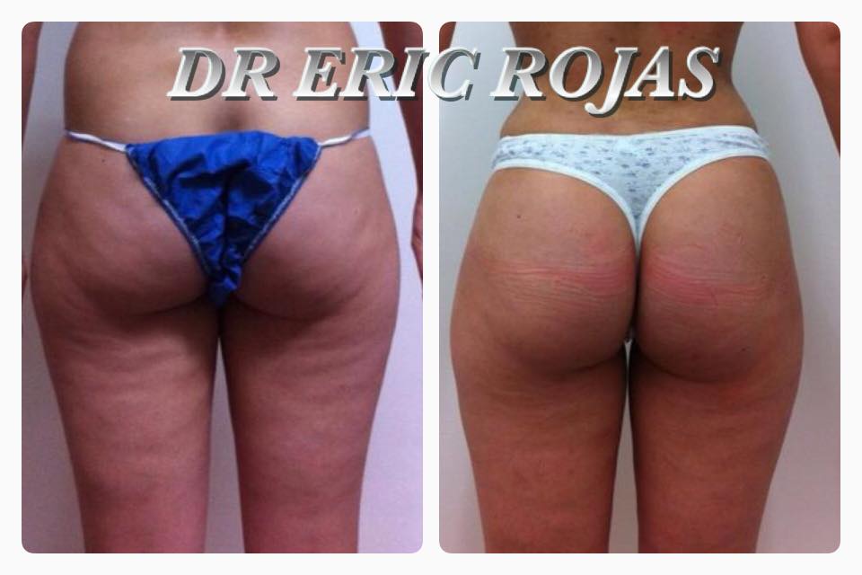 Mejoramos tu cintura y tu celulitis. Contamos con el único LASER aprobado por la FDA