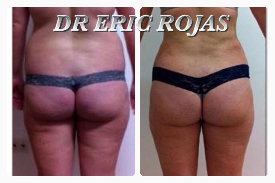 CELULITIS YA NO MÁS. Dr ERIC ROJAS