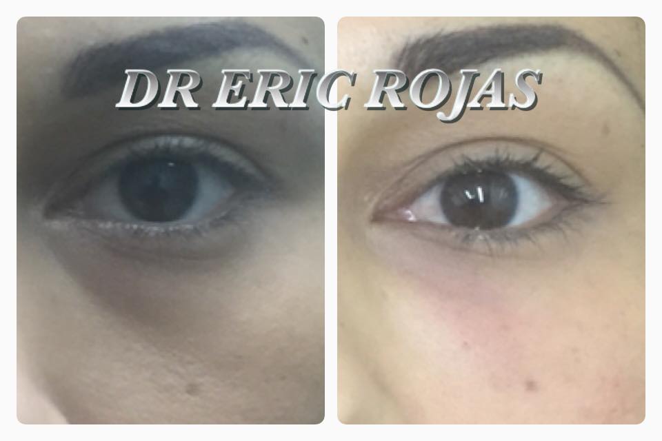 TUS OJERAS YA PUEDES DISMINUIRLAS