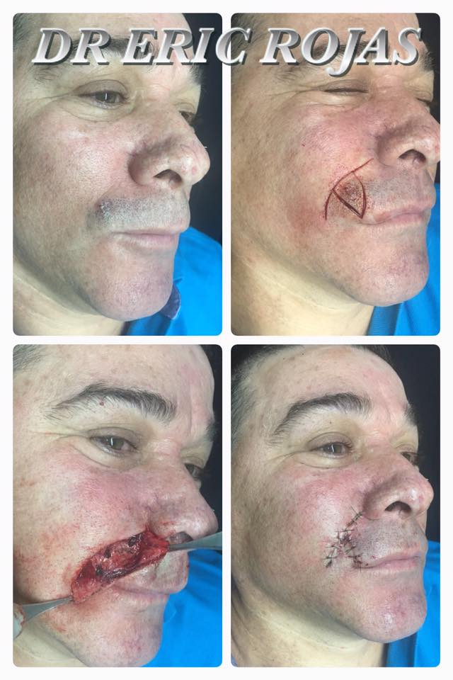 Continuamos recibiendo Cancer de piel