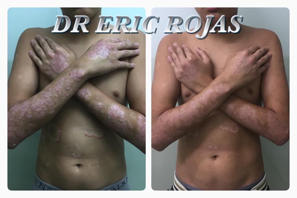 PSORIASIS SEVERA ya con tratamiento de Un mes y medio mejoría de un 80%