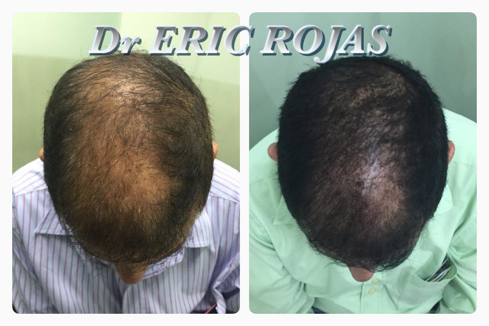 CAÍDA DE CABELLO YA PUEDES TRATARLA DE UNA FORMA SIMPLE Y EFECTIVA