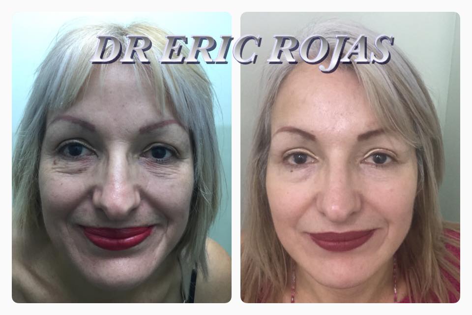 Rejuvenece SIN CIRUGÍA NOSOTROS LOGRAMOS REFRESCAR TU ROSTRO