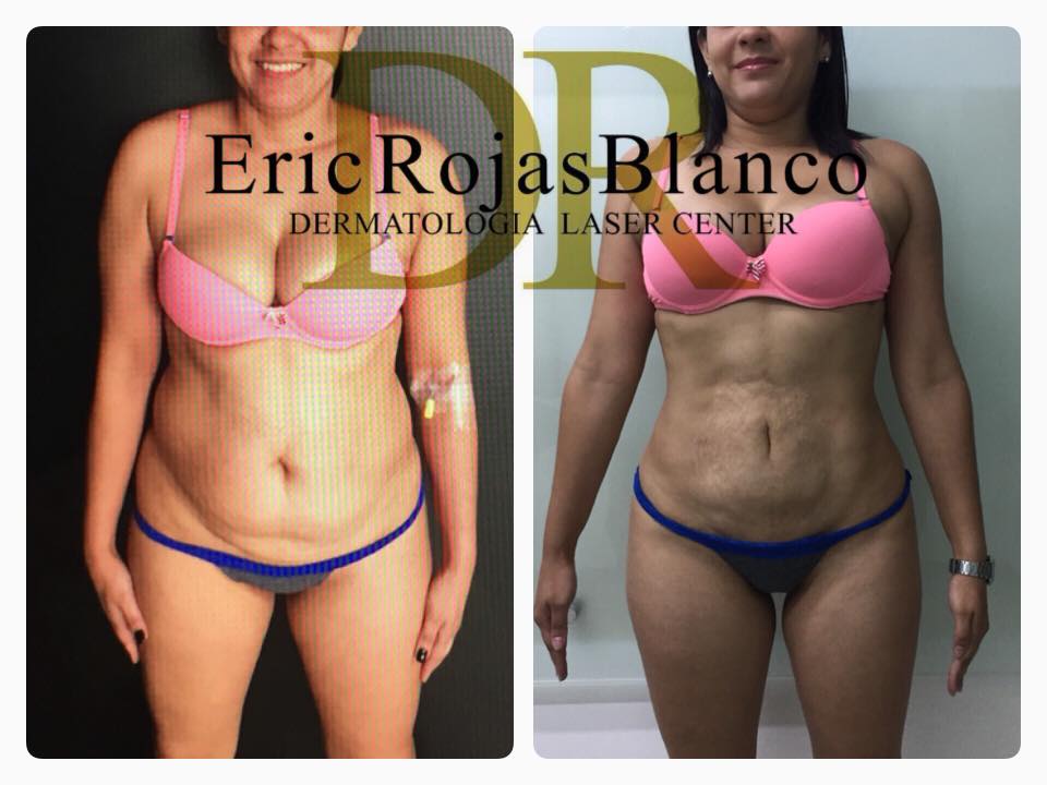 SLIM LASER TE DA CAMBIOS SORPRENDENTES