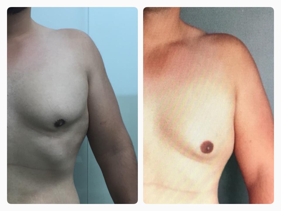 Genecomastia nosotros te la solucionamos con SLIM laser