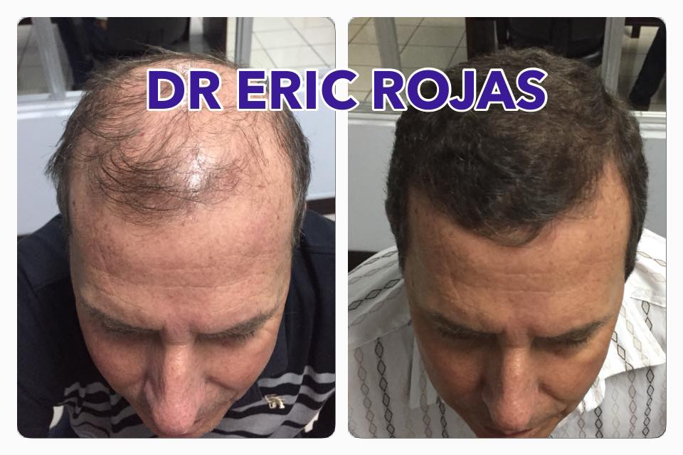 Estás perdiendo CABELLO BUSCA UN ESPECIALISTA EN CAÍDA