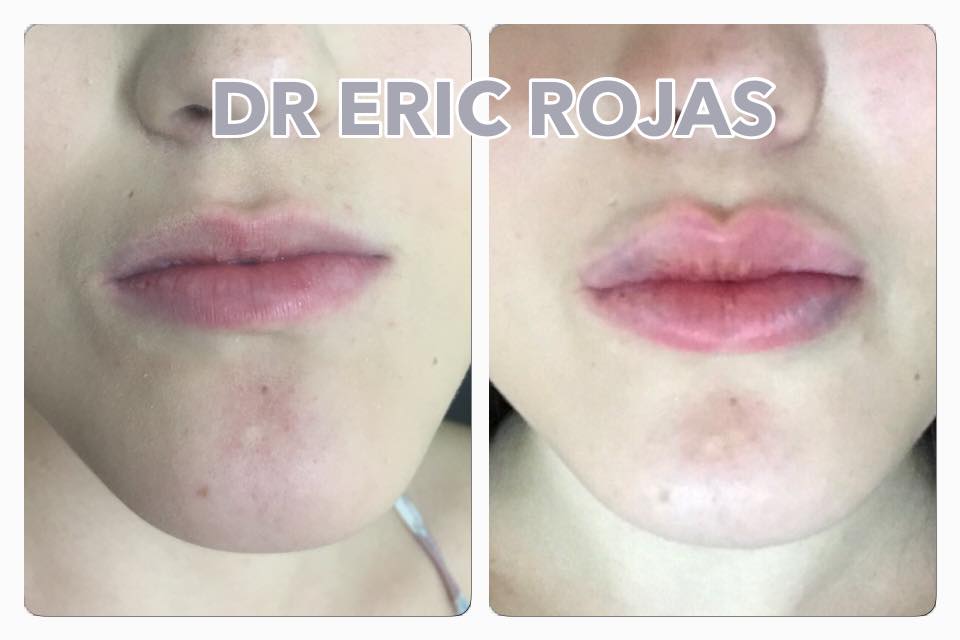 AUNENTO DE LABIOS DE FORMA SUTIL