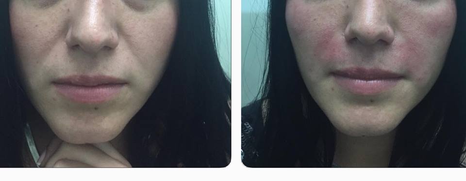 Elimina TUS SURCOS NASOGENIANOS EN MENOS DE 5 minutos.
