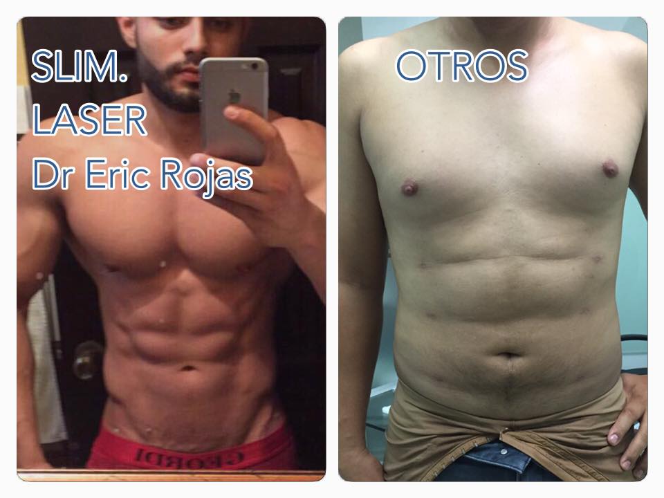 Algunos dices que hacen SLIM LASER Y ASÍ ATRAEN PACIENTES QUE OBTIENEN RESULTADOS COMO ESTE