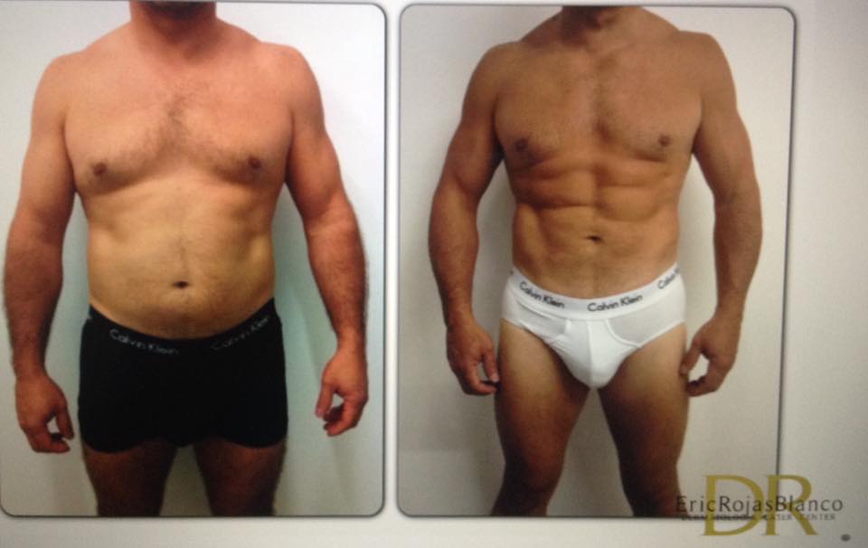 Slim LASER DR ERIC ROJAS.